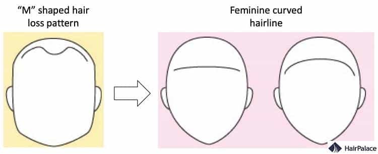 transgender hairline vs mtf hairline